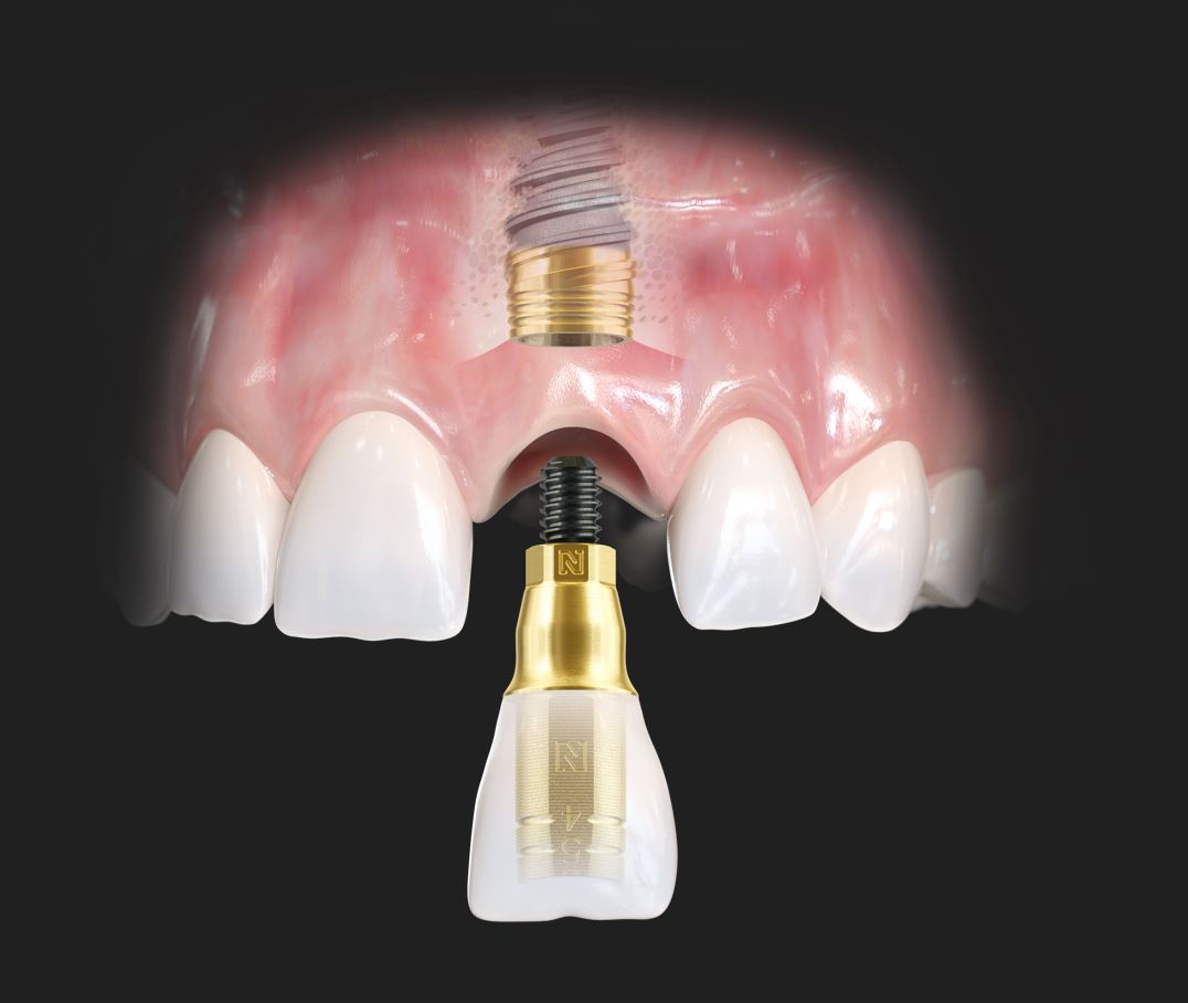 Front tooth dental implant with abutment and crown